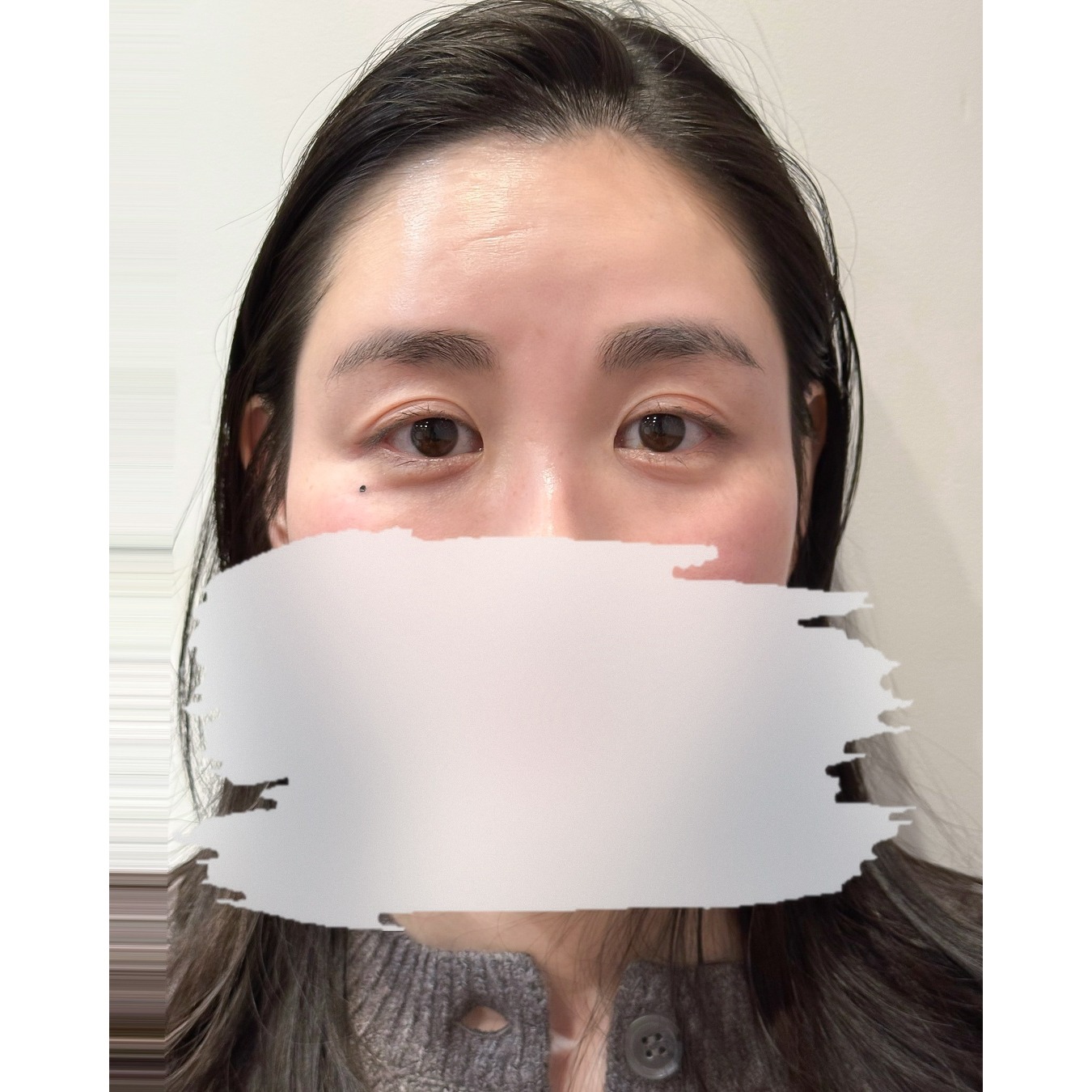 ほくろ After