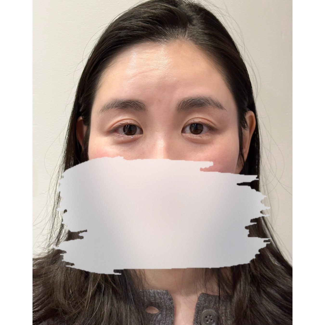 ほくろ Before